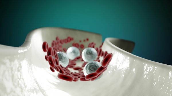 Athérosclérose : mécanismes, risques et stratégies de prévention